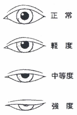 眼瞼下垂の検査 治療 かめざわ眼科 横浜市 上大岡 港南区