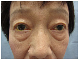 ６０代女性　両眼　加齢性