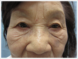 ８６歳女性　右眼　白内障術後